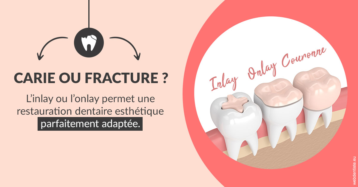 https://dr-faboumy-marc-olivier.chirurgiens-dentistes.fr/T2 2023 - Carie ou fracture 2