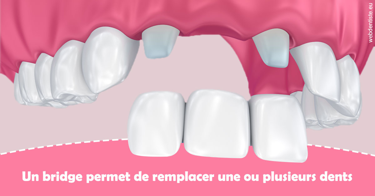 https://dr-faboumy-marc-olivier.chirurgiens-dentistes.fr/Bridge remplacer dents 2