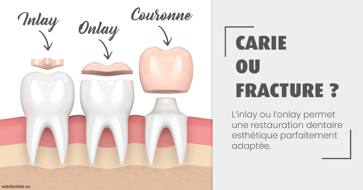 https://dr-faboumy-marc-olivier.chirurgiens-dentistes.fr/T2 2023 - Carie ou fracture 1
