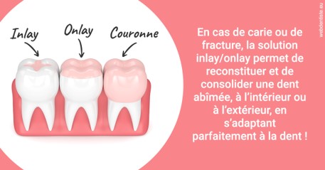 https://dr-faboumy-marc-olivier.chirurgiens-dentistes.fr/L'INLAY ou l'ONLAY 2