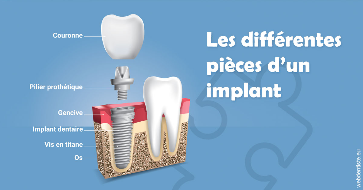 https://dr-faboumy-marc-olivier.chirurgiens-dentistes.fr/Les différentes pièces d’un implant 1