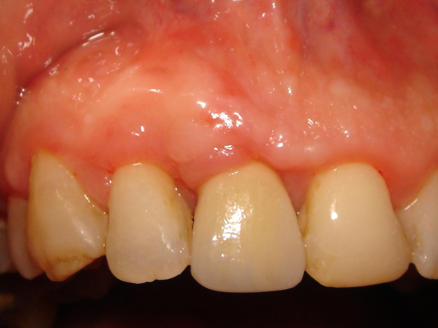 2- la dent a été extraite, il y a eu greffe d'os et de gencive simultanée. 4 mois apres une pose d'implant et une couronne