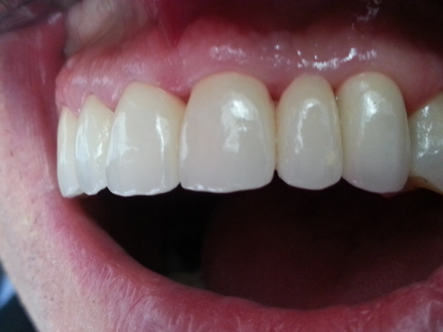 5-defi relevé, la position de la gencive est stable au niveau de la dent extraite